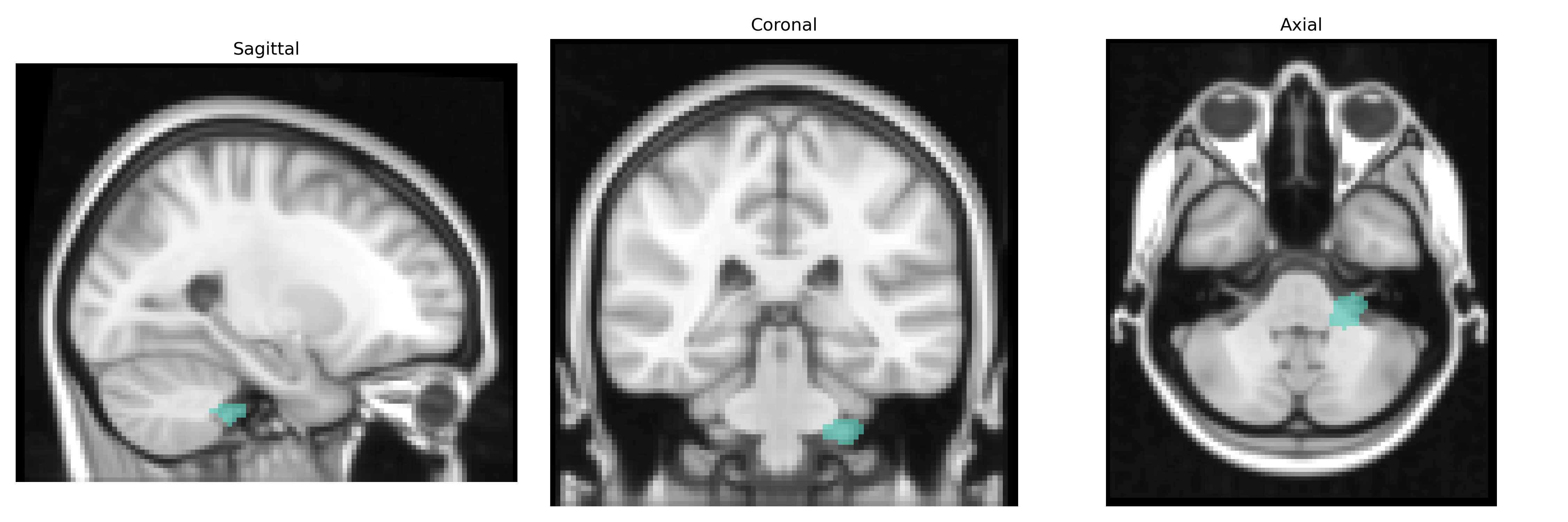 Triplanar T1
