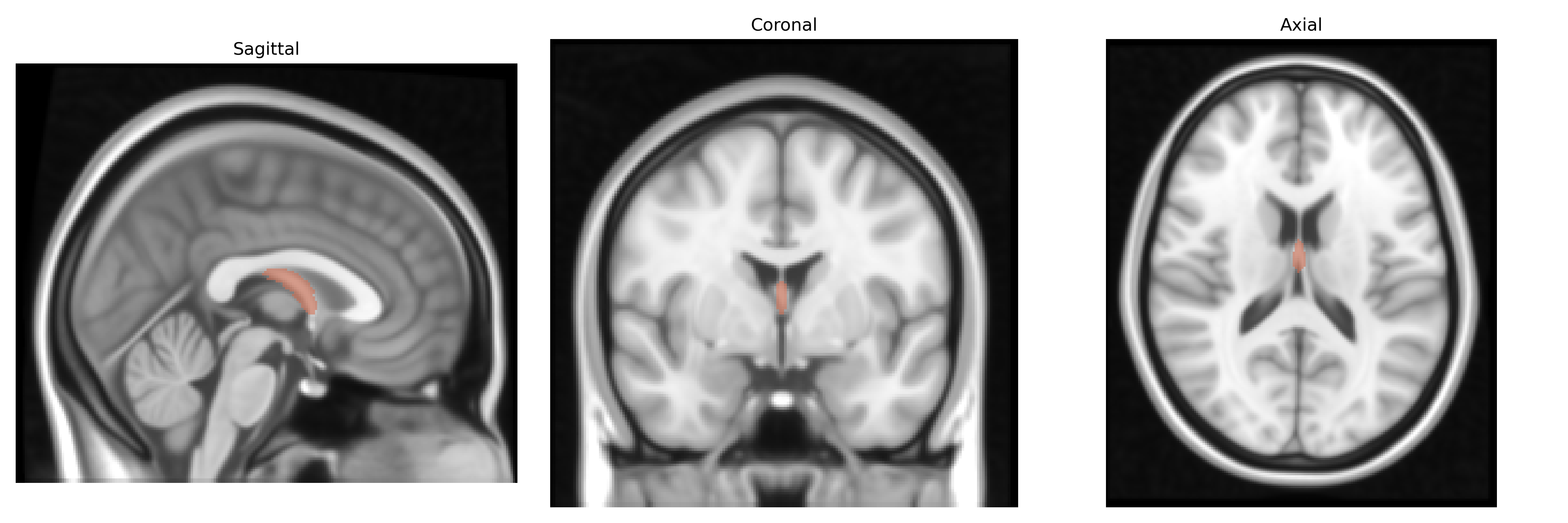 Triplanar T1