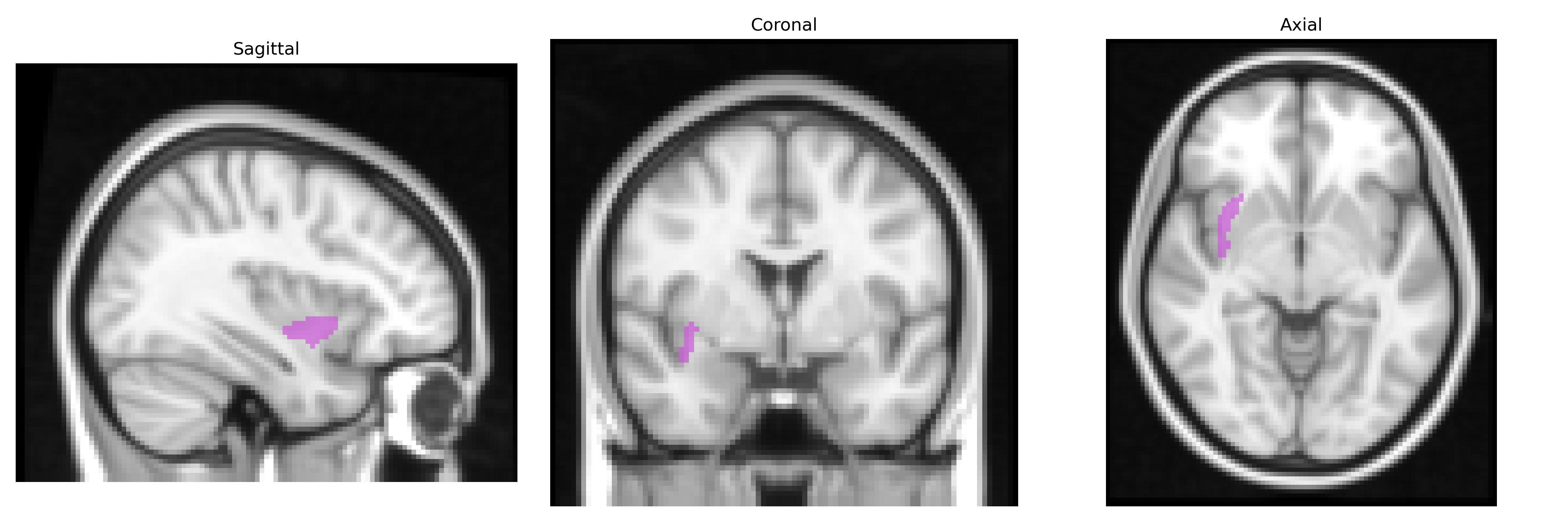 Triplanar T1