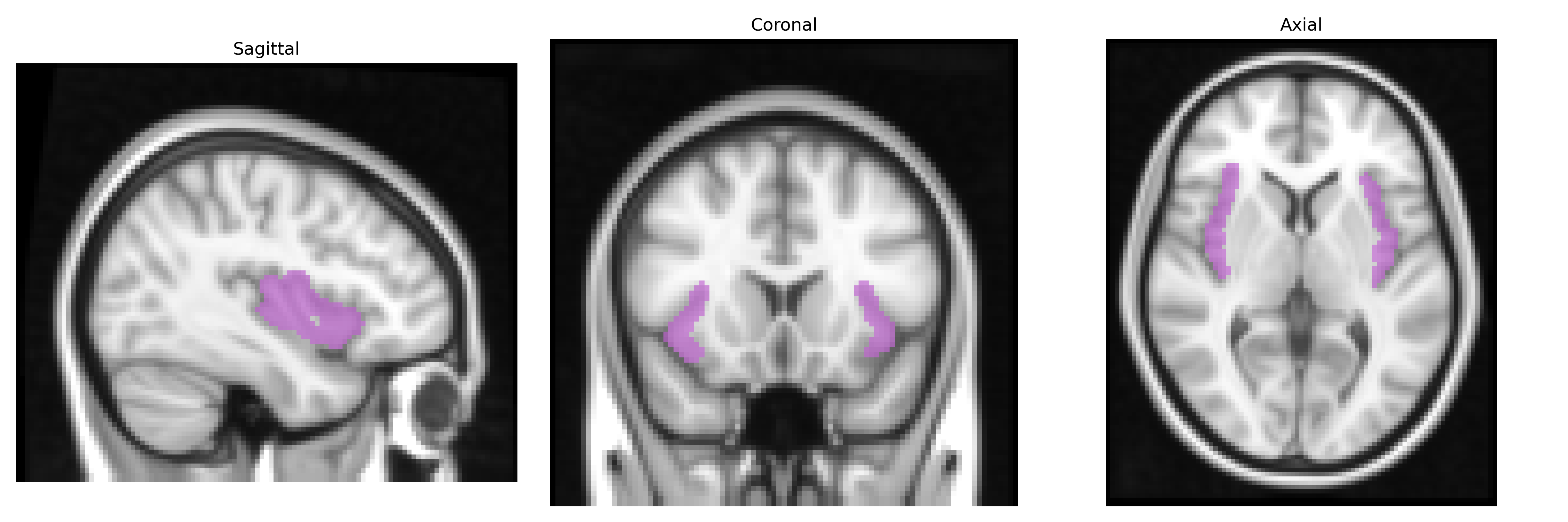 Triplanar T1