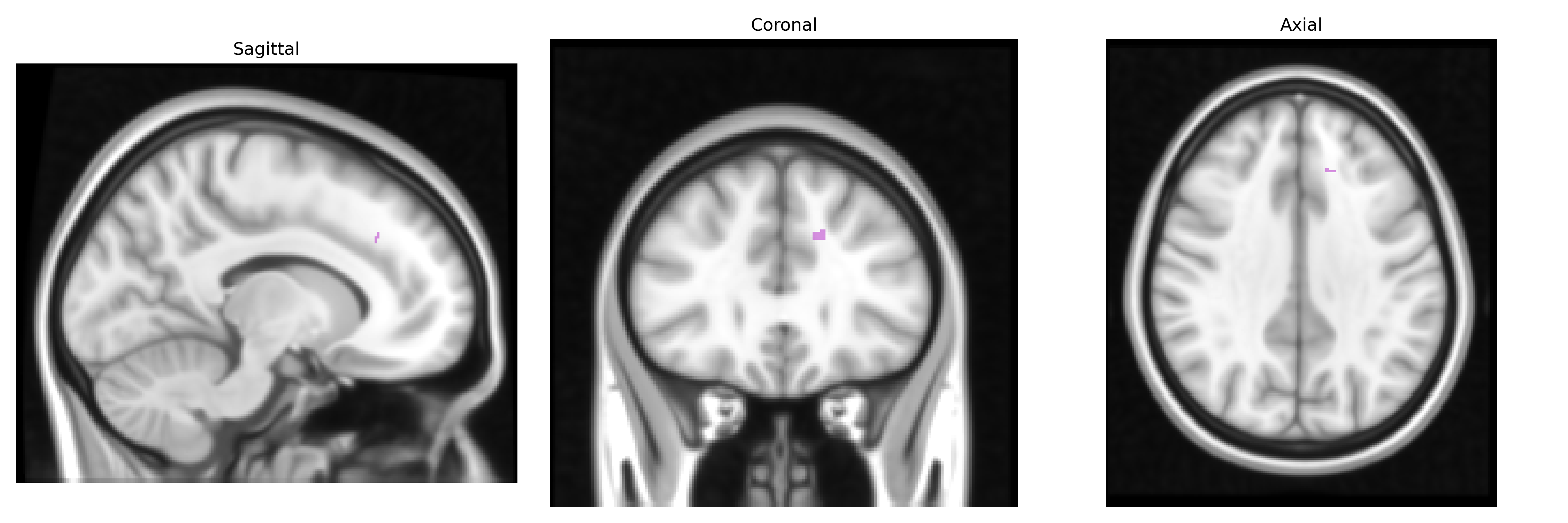 Triplanar T1
