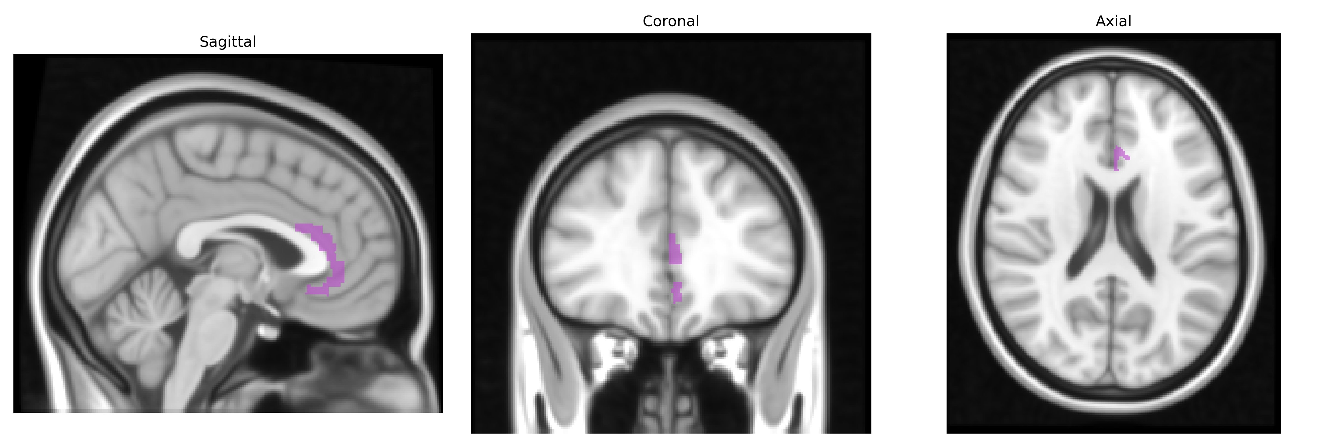 Triplanar T1