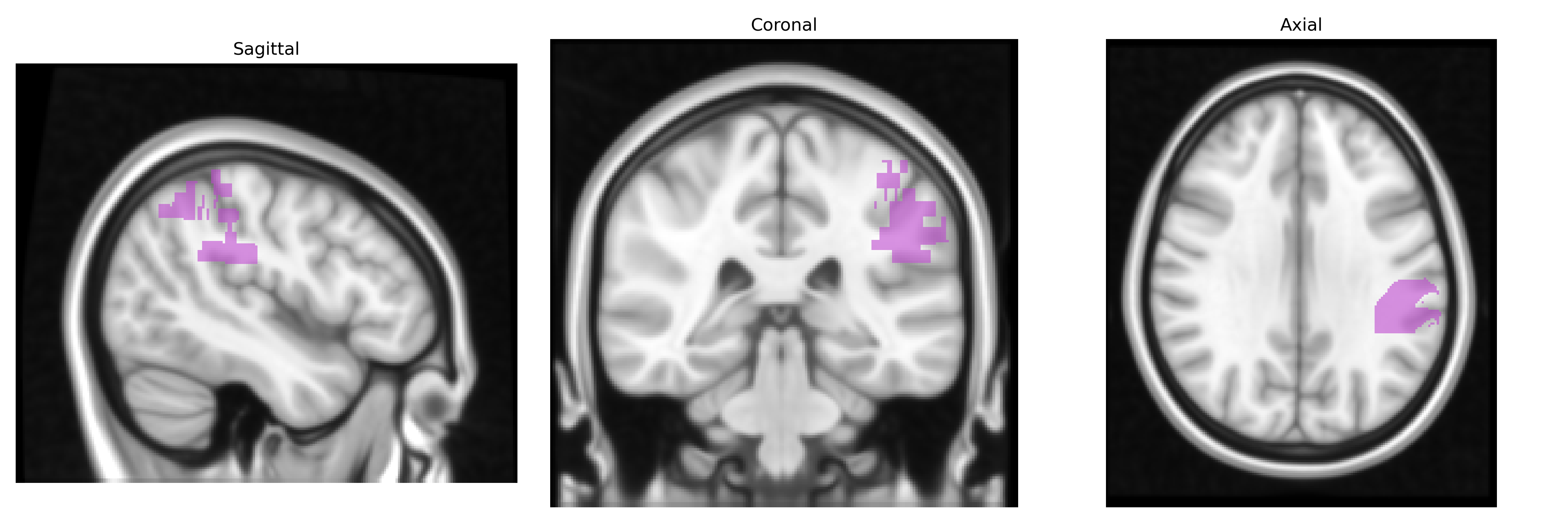 Triplanar T1