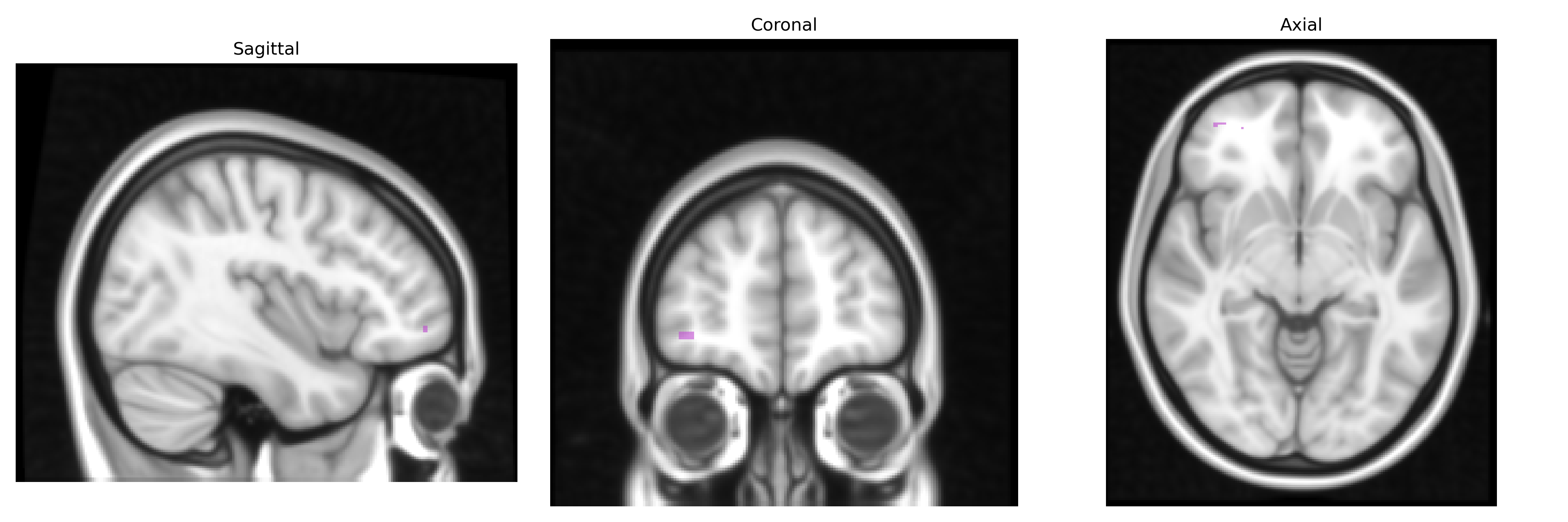 Triplanar T1