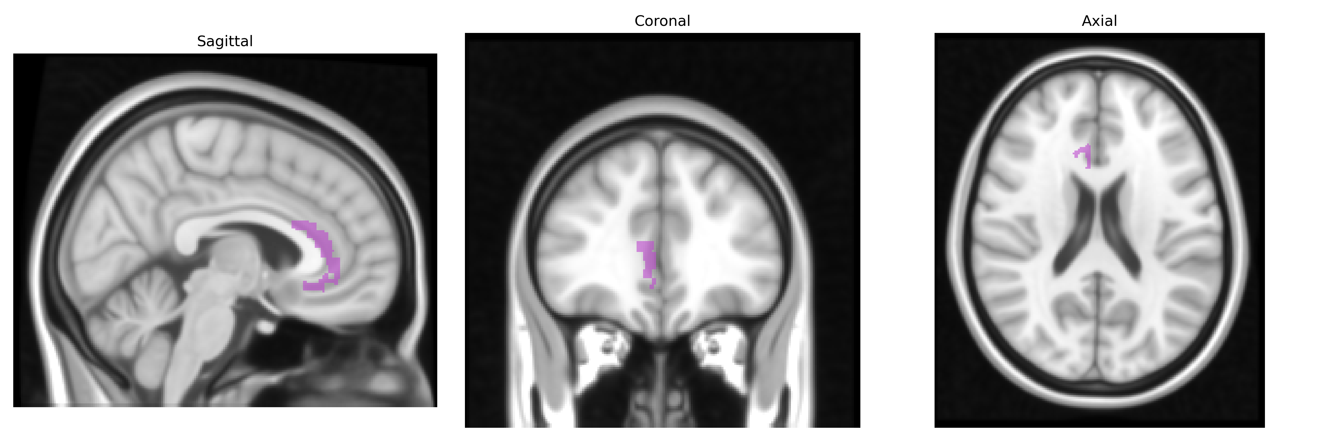 Triplanar T1