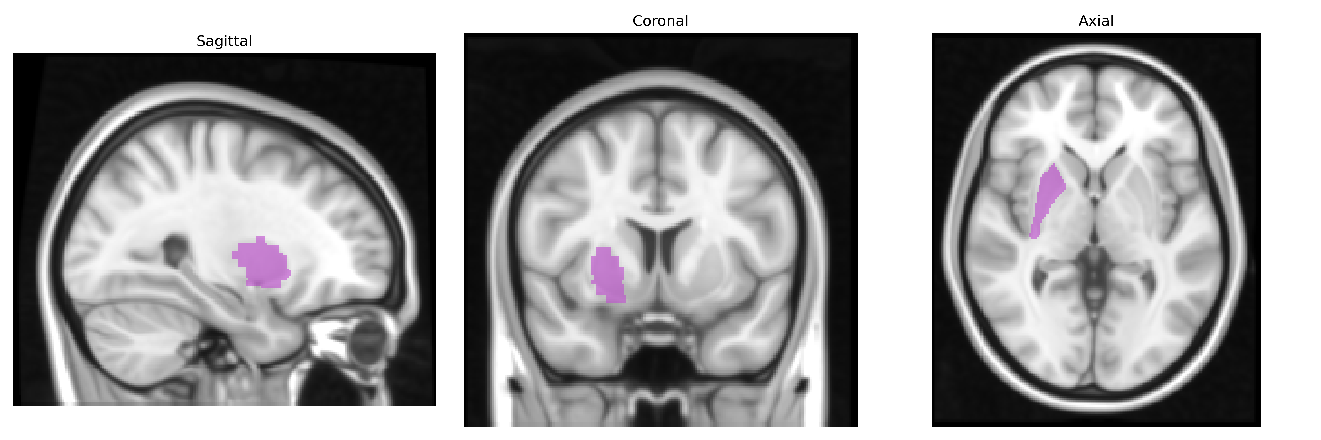 Triplanar T1