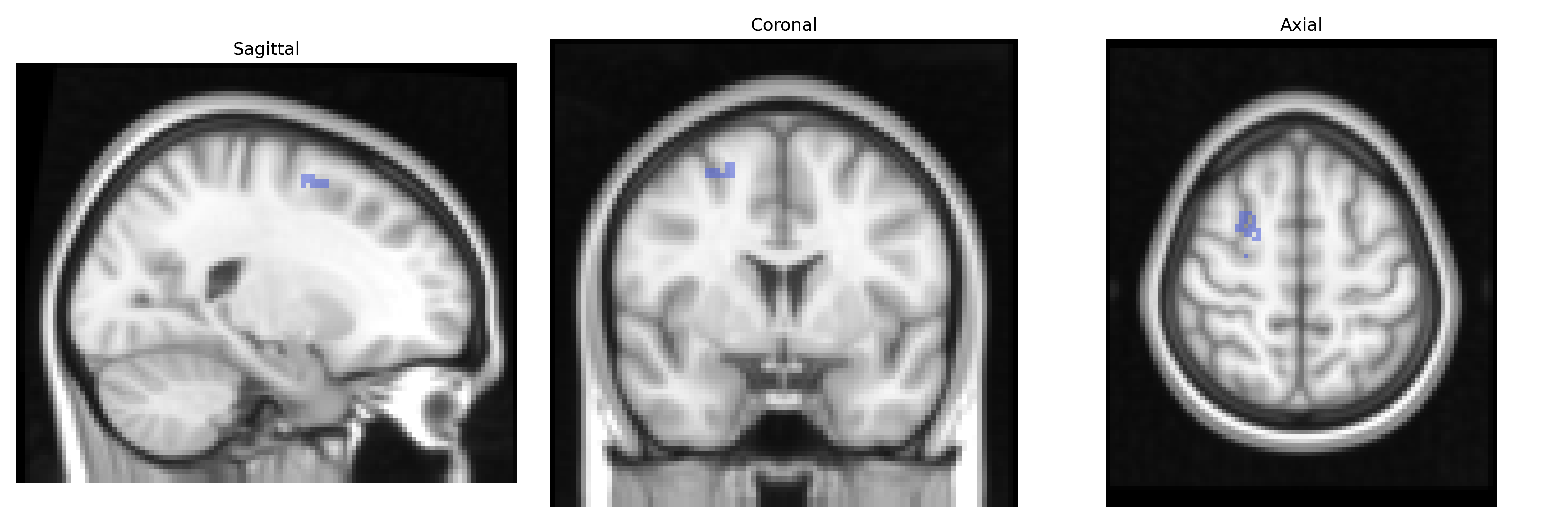 Triplanar T1