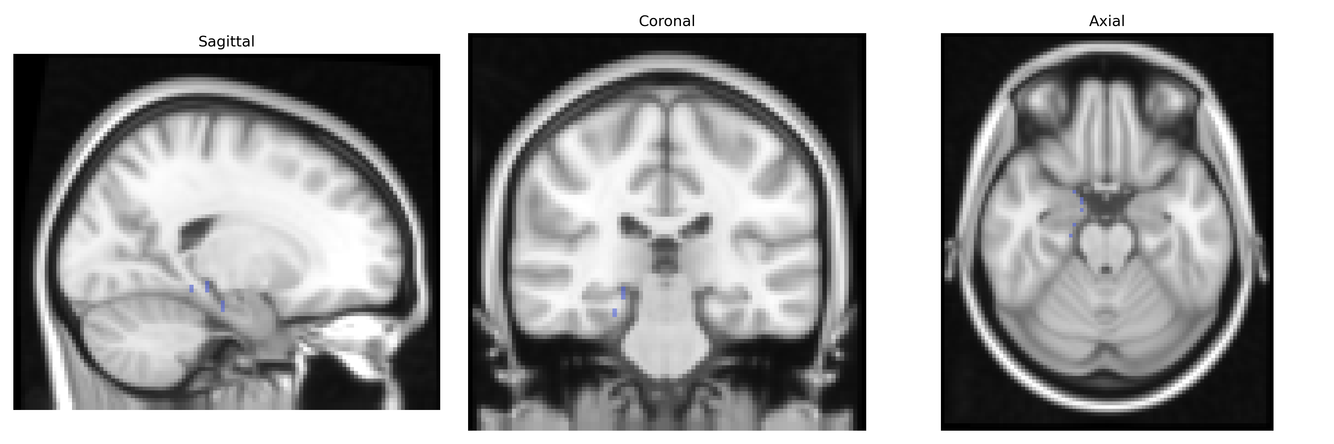 Triplanar T1